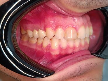 İşıqlandırma: Məhsul: Smartfon üçün diş həkimi çəkiliş seti – LED halqa işıqlı — 4