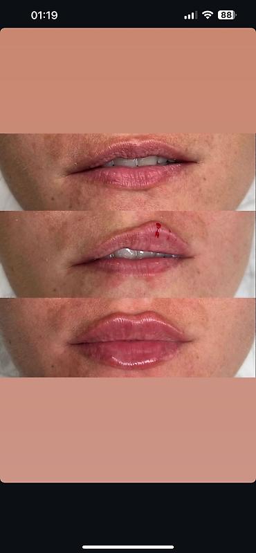 Косметология: Косметология, Ботокс, Биоревитализация, Ботулинотерапия, Консультация, Гипоаллергенные материалы, Сертифицированный косметолог at lalafo.kg — 20 Косметология: Косметология, Ботокс, Биоревитализация, Ботулинотерапия, Консультация, Гипоаллергенные материалы, Сертифицированный косметолог — 20