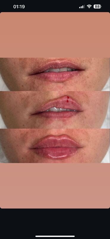 Косметология: Косметология, Ботокс, Биоревитализация, Ботулинотерапия, Консультация, Гипоаллергенные материалы, Сертифицированный косметолог — 21