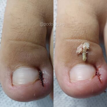 Маникюр, педикюр: Коррекция вросших ногтей, Педикюр, Услуги подолога, Консультация, Одноразовые расходные материалы — 2
