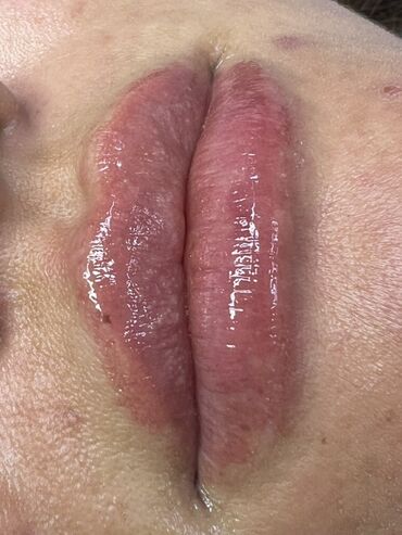 Косметология: Косметология, Маски, Мезотерапия, Удаление носогубных складок, Гипоаллергенные материалы, Консультация, Сертифицированный косметолог — 71