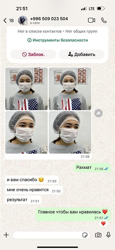 Брови: Нитевая блефаропластика «Сингапури» без операции ✨ Процедура — 3