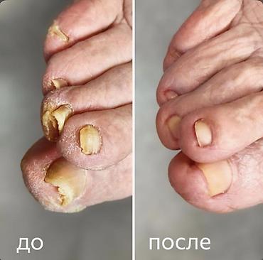 обувь 34: Услуги подолога (Жалал-Абад) Специализация: - Лечение вросшего ногтя — 6