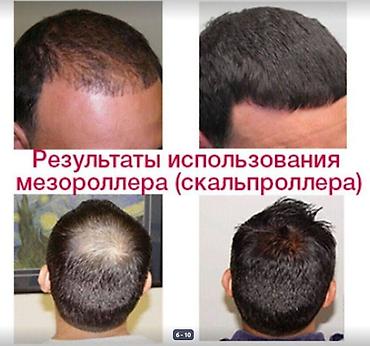 для роста волос: АППАРАТ ОТ ОБЛЫСЕНИЯ И НЕ ТОЛЬКО МНОГО ВИДОВ ВСЕ В ТЕМЕ читаем — 7