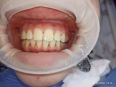 Ортезы: Ортодонтическое лечение: установка брекет‑системы на нижнюю челюсть - — 4