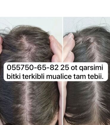 qara sabun sac ucun: Saç maskası, Saç tökülməsinə qarşı