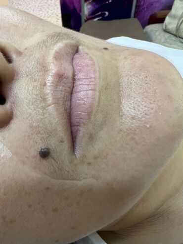 Косметология: Косметология, Маски, Мезотерапия, Удаление носогубных складок, Гипоаллергенные материалы, Консультация, Сертифицированный косметолог — 84