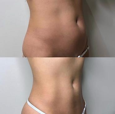 Красота и здоровье: Lipo Lab V-Line Solution — инъекционный липолитик для коррекции — 7
