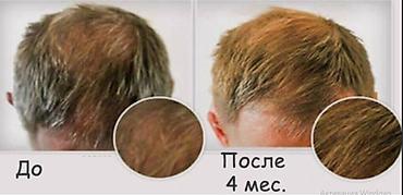 Уход за телом: Мезороллер разные размеры игл - прямые поставки - читаем текст смотрим — 7