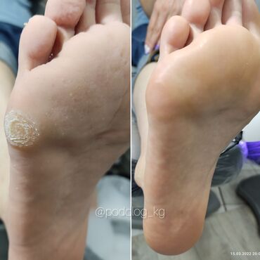 Маникюр, педикюр: Коррекция вросших ногтей, Маникюр, Педикюр, Услуги подолога, Консультация — 2