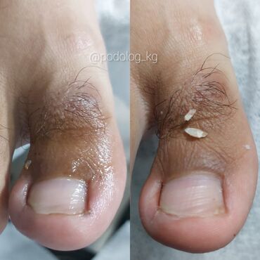 Маникюр, педикюр: Коррекция вросших ногтей, Педикюр, Услуги подолога, Консультация, Одноразовые расходные материалы — 11