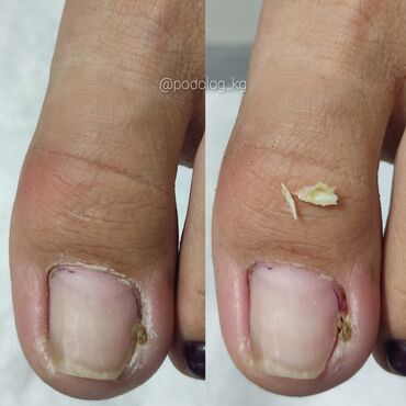 Маникюр, педикюр: Коррекция вросших ногтей, Педикюр, Услуги подолога, Консультация, Одноразовые расходные материалы — 7