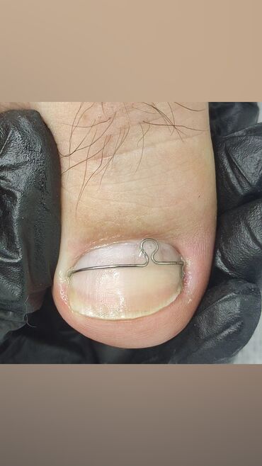 Маникюр, педикюр: Коррекция вросших ногтей, Маникюр, Педикюр, Услуги подолога, Консультация, Одноразовые расходные материалы — 5