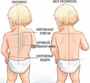 Корректоры осанки: Корсеты, корректоры осанки, пояса для спины, реклинаторы 9-11 — 3