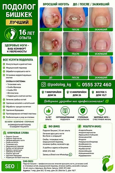 Ичине кирип өскөн тырмактарды оңдоо, Подолог кызматтары, 4 кол кызматы, Консультация, Бир жолку сарпталуучу материалдар