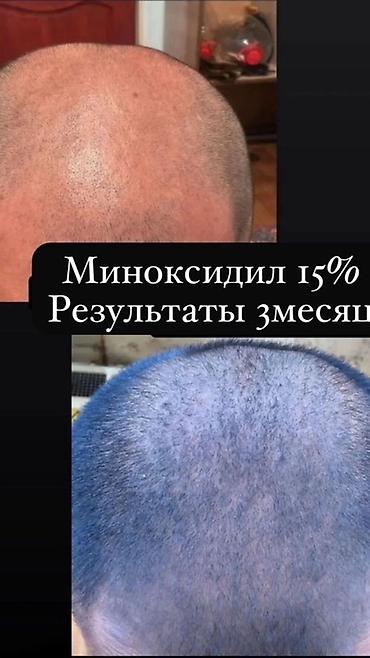 алопеция: Миноксидил Kirkland Signature — средство для стимуляции роста волос — 4