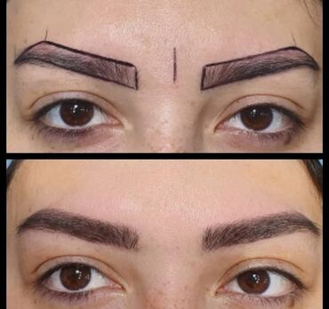 Kirpiklər, qaşlar: Seyrek formasiz qaslarin mikrobledinqle berpasi — 4