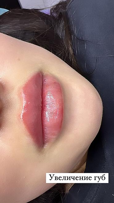 Косметология: Косметология, Ботокс, Биоревитализация, Ботулинотерапия, Консультация, Гипоаллергенные материалы, Сертифицированный косметолог at lalafo.kg — 25 Косметология: Косметология, Ботокс, Биоревитализация, Ботулинотерапия, Консультация, Гипоаллергенные материалы, Сертифицированный косметолог — 25