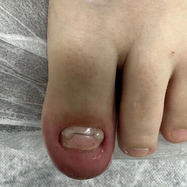 Маникюр, педикюр: Коррекция вросших ногтей, Маникюр, Педикюр, Услуги подолога, Консультация, Одноразовые расходные материалы — 20