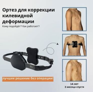 ортез в аренду: Ортез для коррекции килевидной деформации грудной клетки — это