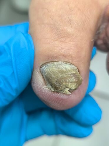 маникюр педикюр с выездом на дом: Коррекция вросших ногтей, Педикюр, Одноразовые расходные материалы