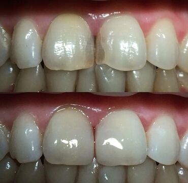 витилиго как лечить: Стоматолог | Реставрация, Протезирование, Чистка зубов | Консультация
