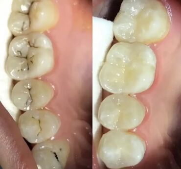 художественная реставрация зубов композитными материалами: Клиника | Стоматолог | Другие медицинские услуги