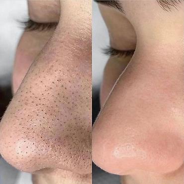 qara rəng: Alora Beauty – qaralıq və ləkələrə qarşı qabıqlanma effekti ilə baxım — 4