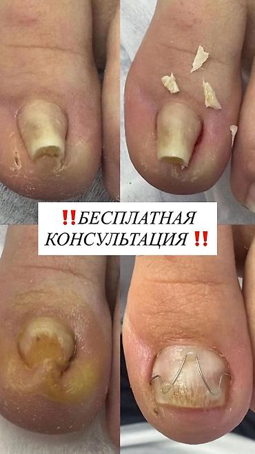 Подологические услуги - Коррекция вросшего ногтя без хирургии lalafo.kg да Подологические услуги - Коррекция вросшего ногтя без хирургии