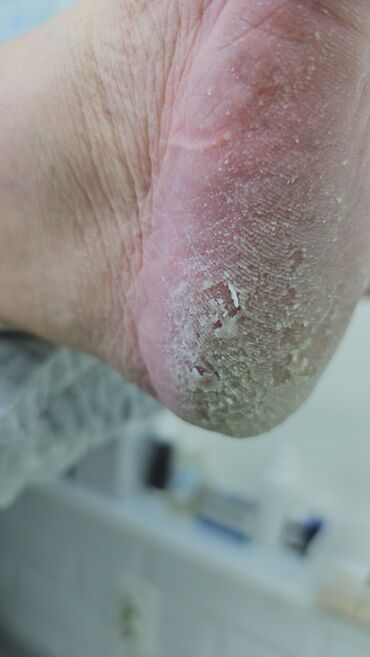 Маникюр, педикюр: Коррекция вросших ногтей, Маникюр, Педикюр, Услуги подолога, Консультация, Одноразовые расходные материалы — 10