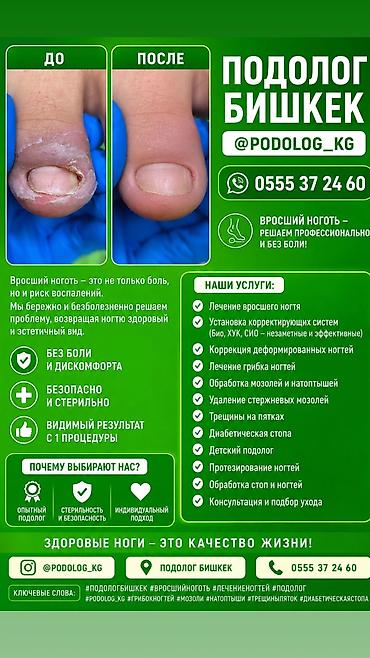 Ичине кирип өскөн тырмактарды оңдоо, Подолог кызматтары, Консультация, Бир жолку сарпталуучу материалдар