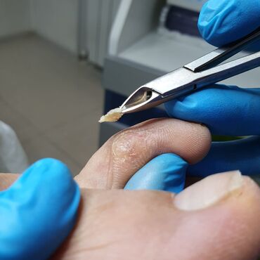 Маникюр, педикюр: Коррекция вросших ногтей, Маникюр, Педикюр, Услуги подолога, Консультация — 17