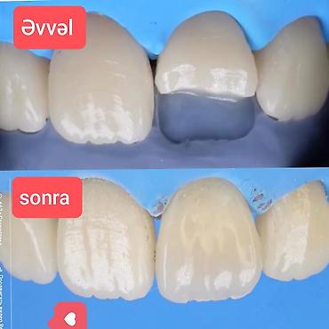 diş plomb qiyməti: İndi Daha Rahat və Estetik 💠 Qiymətlər Türkiyə plomb – 30₼ Almaniya — 1