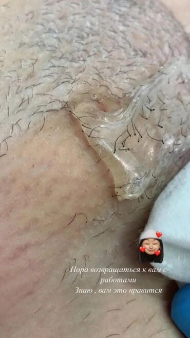 Эпиляция: Шугаринг (депиляция сахарной пастой) Зоны: - Подмышки - Ноги (голени) — 4