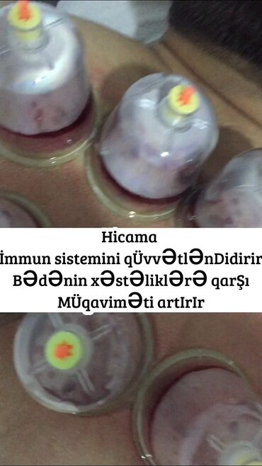 Hicama, zəli: Hicamanın Faydaları✅ *Qan dövranın pozulması *Qanın təmizlənməsi — 8