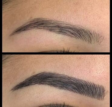 Kirpiklər, qaşlar: Seyrek formasiz qaslarin mikrobledinqle berpasi — 8