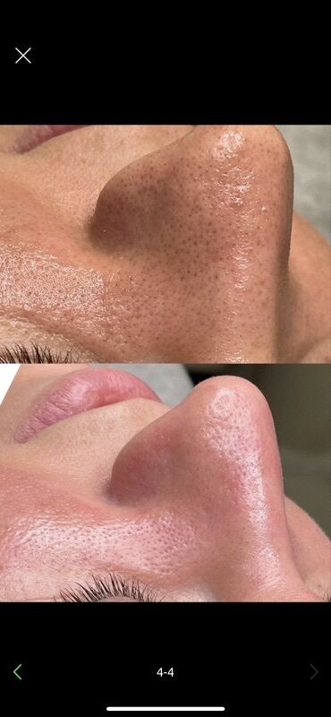 Косметология: Косметология, Ботокс, Биоревитализация, Ботулинотерапия, Консультация, Гипоаллергенные материалы, Сертифицированный косметолог — 49