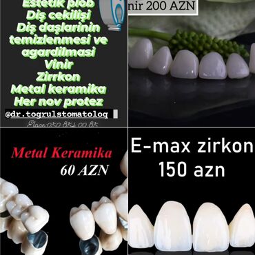 zirkon qapaq qiymeti: Stomatologiya | Keramika, Diş daşlarının təmizlənməsi, Plomblanması