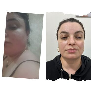 Hicama, zəli: Xidmət: Kupa terapiyası (quru və yaş/hicama), bel–boyun–çiyin masajı — 17