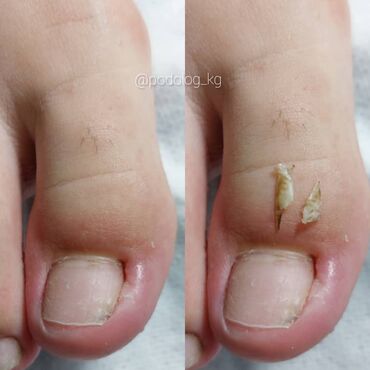 Маникюр, педикюр: Коррекция вросших ногтей, Педикюр, Услуги подолога, Консультация, Одноразовые расходные материалы — 6