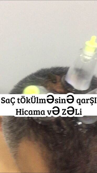 Hicama, zəli: Hicamanın Faydaları✅ *Qan dövranın pozulması *Qanın təmizlənməsi — 4