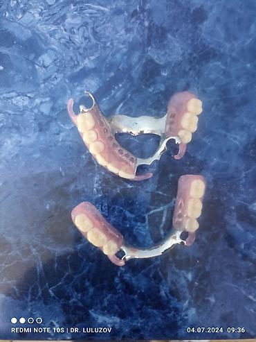 Ортезы: Съемные частичные зубные протезы - Тип: частичные протезы для верхней — 13