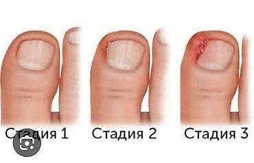 Красота и здоровье: Услуги подолога: коррекция вросшего ногтя (стадии 1–3) - — 1