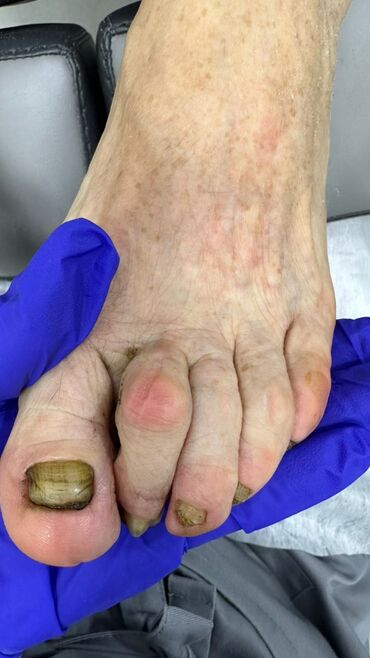 Маникюр, педикюр: Коррекция вросших ногтей, Маникюр, Педикюр, Услуги подолога, Консультация, Одноразовые расходные материалы — 2