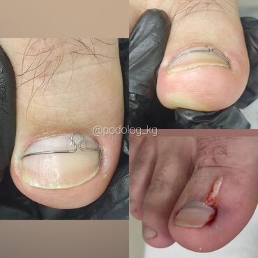 Маникюр, педикюр: Коррекция вросших ногтей, Маникюр, Педикюр, Услуги подолога, Консультация, Одноразовые расходные материалы — 7