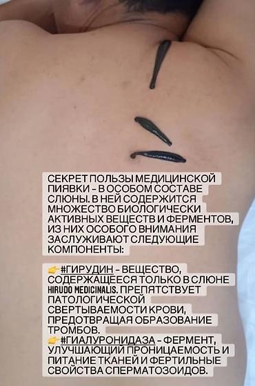 лечение варикоза: Врачи | Гирудотерапевт | Лечение пиявками — 9