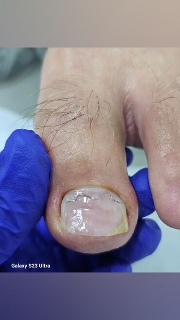 Маникюр, педикюр: Коррекция вросших ногтей, Выравнивание, Услуги подолога, Маникюр, Педикюр, С выездом на дом, Консультация, Одноразовые расходные материалы — 10