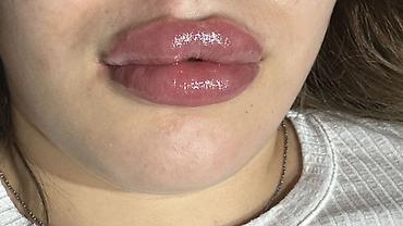 Косметология: Косметология, Увеличение губ, Гипоаллергенные материалы at lalafo.kg — 16 Косметология: Косметология, Увеличение губ, Гипоаллергенные материалы — 16