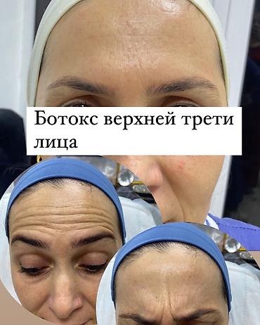 Ботокс – коррекция мимических морщин Услуга: - Инъекции ботулотоксина