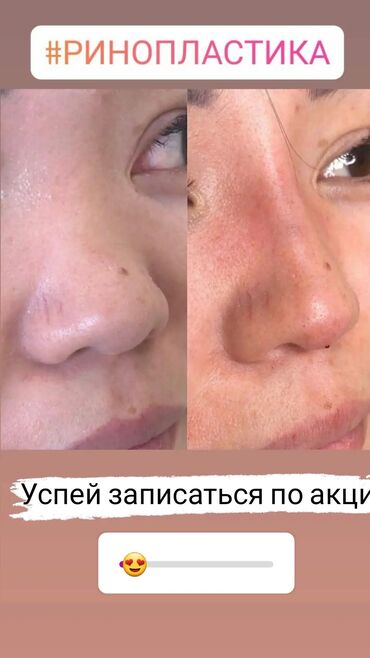 сколько зарабатывают косметологи в бишкеке in Кыргызстан | КОСМЕТОЛОГИЯ: Косметолог | Ботокс, Биоревитализация, Ботулинотерапия | Консультация, Гипоаллергенные материалы, Сертифицированный косметолог
